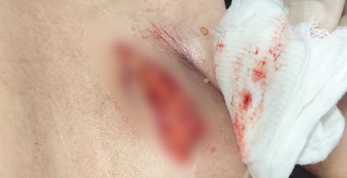 Taburcu edilmek istenen çocuğun idrar kesesinin patladığı ortaya çıktı